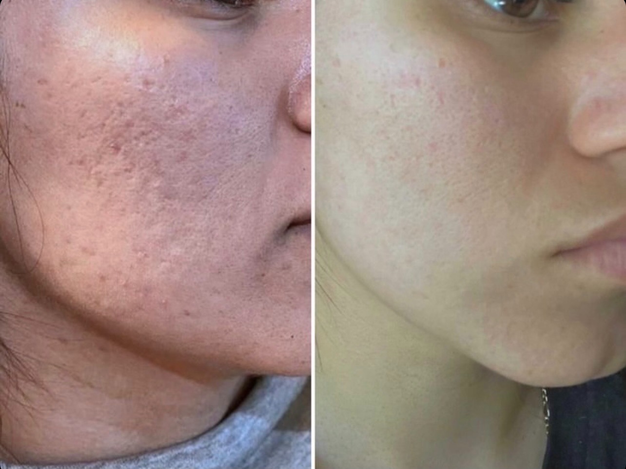 get rid of acne scars with Microneedling Los Angeles 4