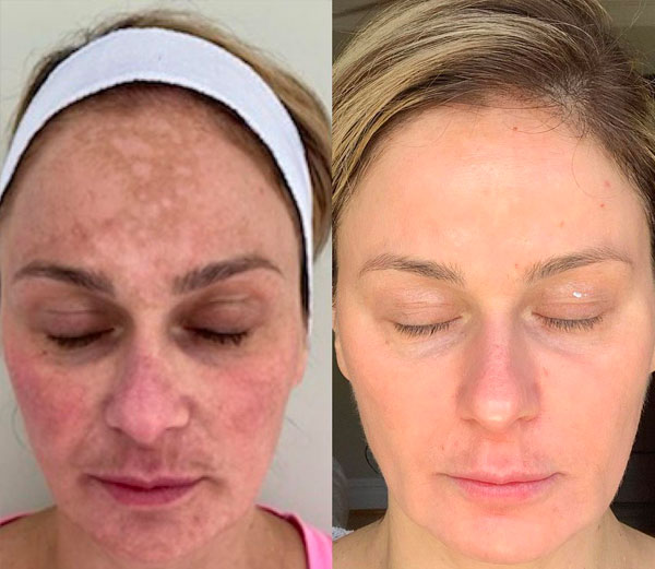 Cosmelan Peel treatment Los Angeles