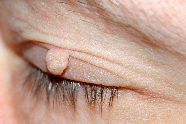 Get rid of the eyelid skin tags Los Angeles