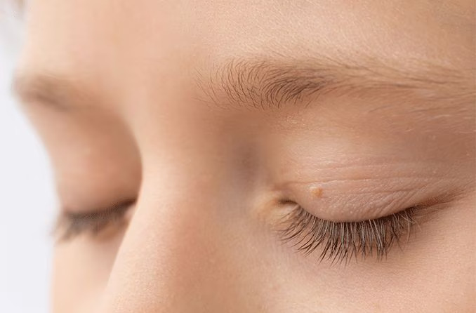 Understanding skin tags on eyelids and an effective solution Los Angeles
