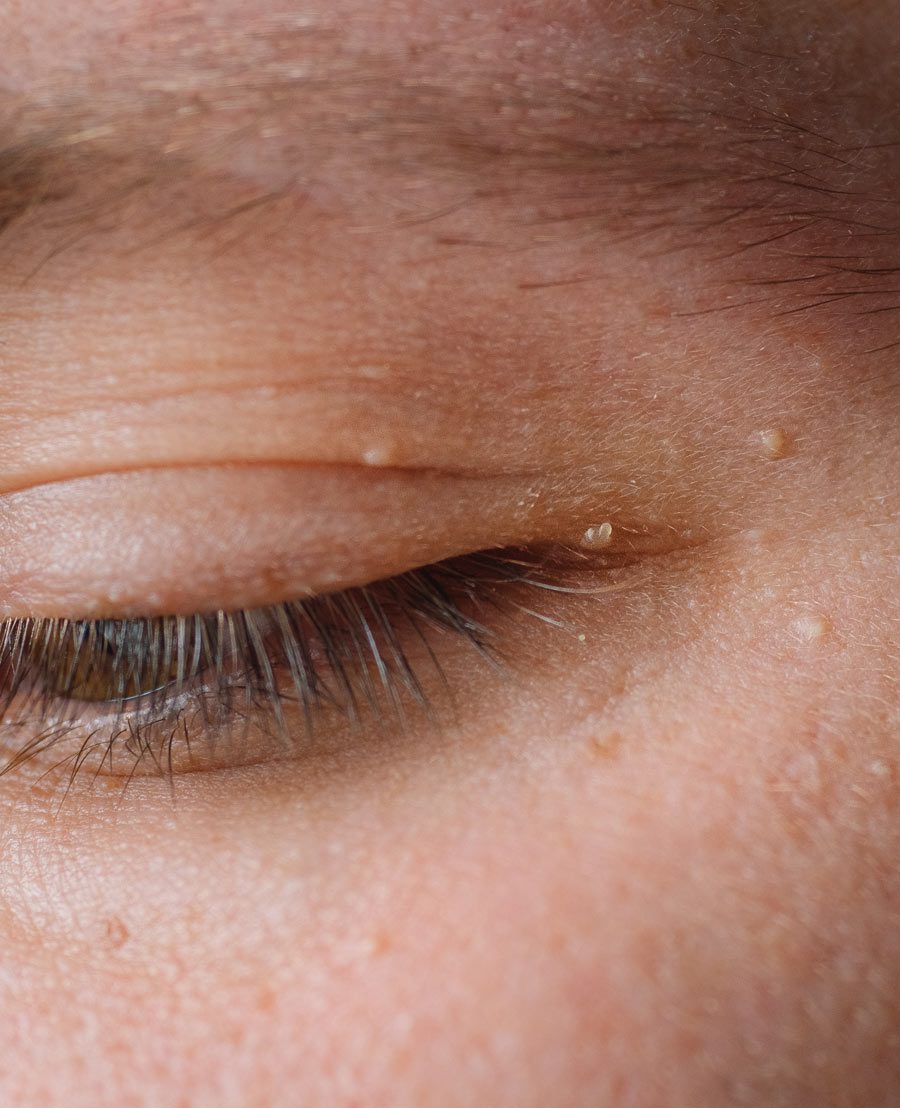 eyelid skin tag removal Los Angeles