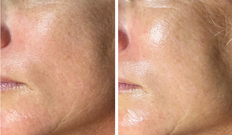 Diamond Glow for skin dehydration Los Angeles