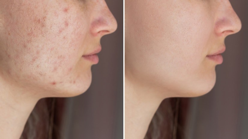 Lumecca IPL for a scarred face before-after Los Angeles