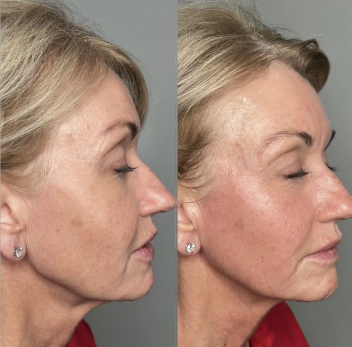 Radiofrequency Skin Tightening Before and After Los Angeles