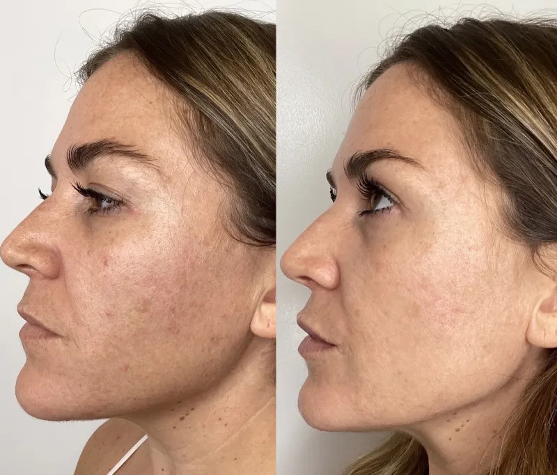 benefits of Lumecca IPL Los Angeles