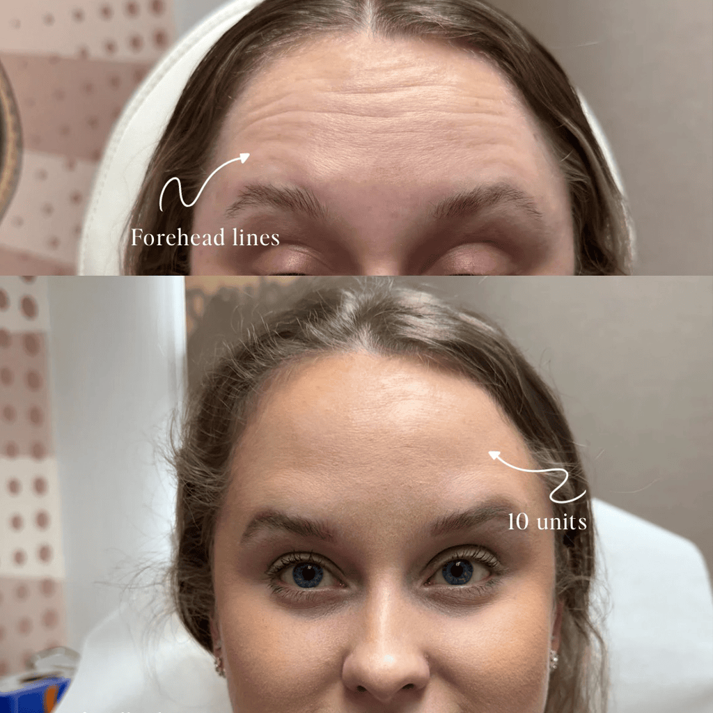 forehead lines treatment