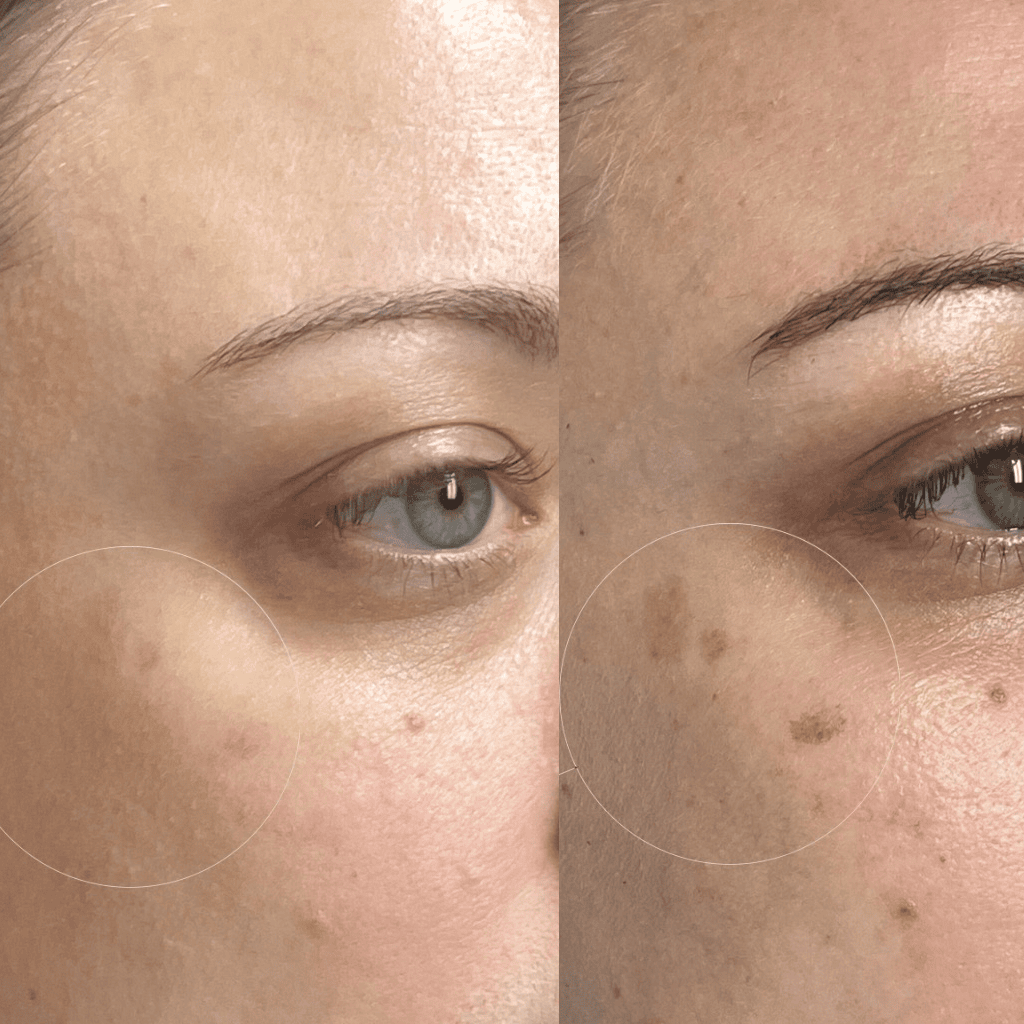 ipl dark spots