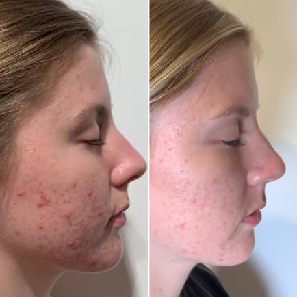 scarring face treatment with IPL Los Angeles
