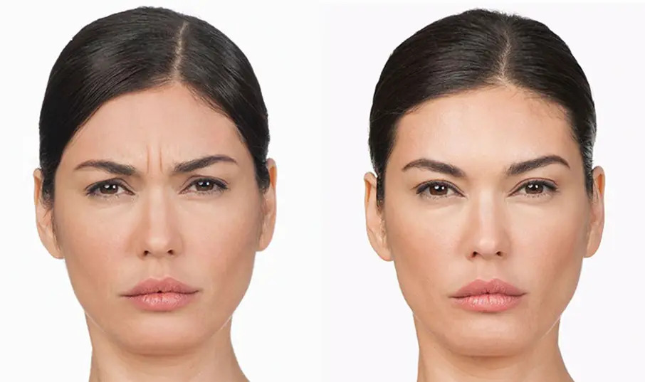 Dysport eyebrow lift before after Los Angeles