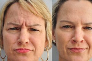 frown lines treatment with Dysport Los Angeles
