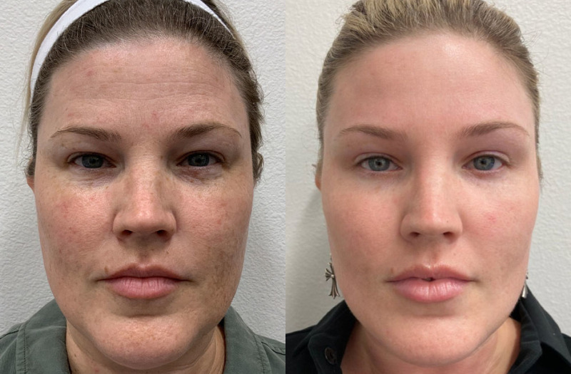 CoolPeel CO₂ for skin discoloration Los Angeles