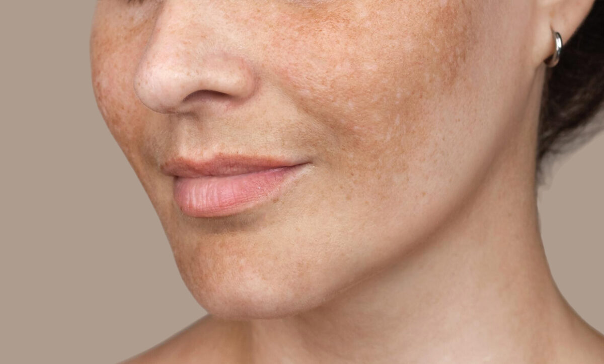 Skin discoloration treatment with CoolPeel CO₂ Los Angeles