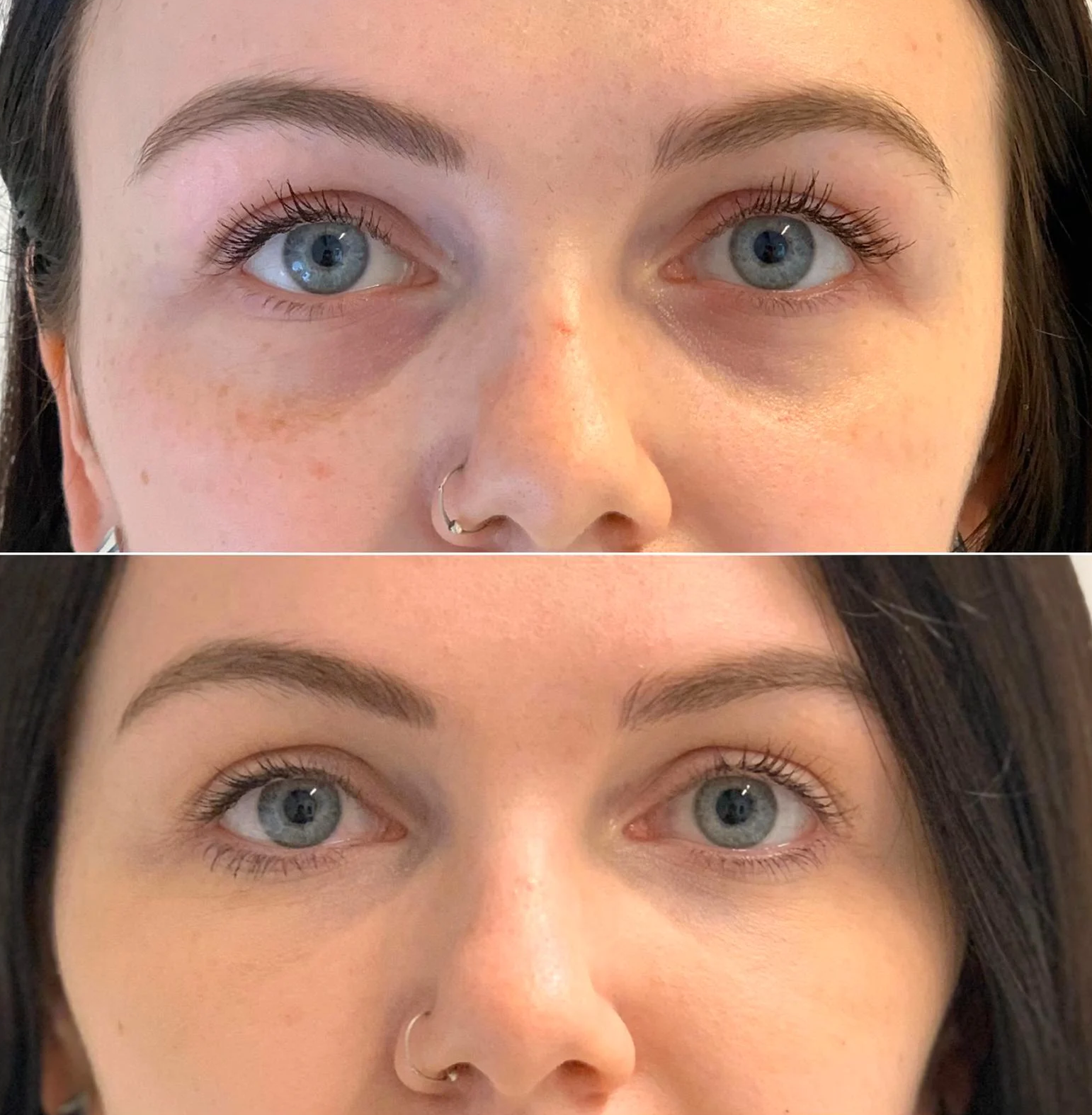 dermal fillers for under-eye hollows Los Angeles