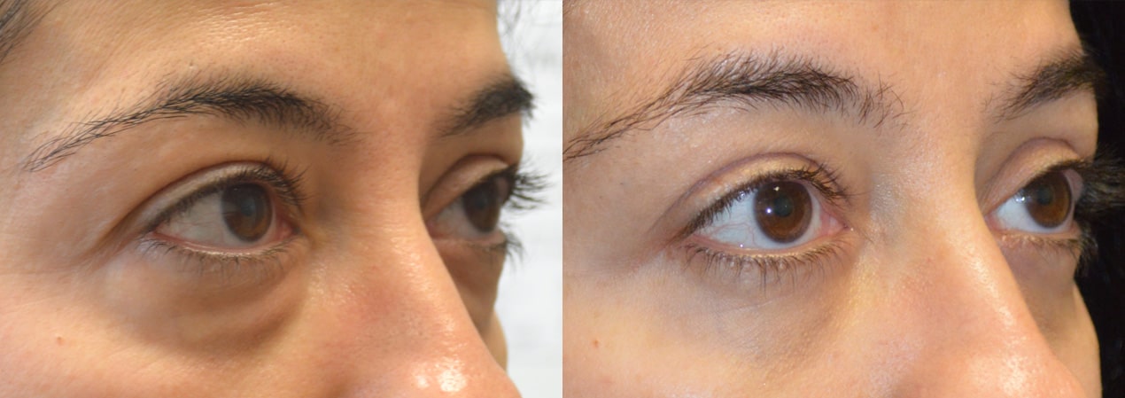 dermal fillers under the eyes Los Angeles
