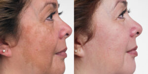 hyperpigmentation treatment with CO2 laser before-after Los Angeles