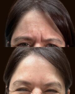 frown line injections los angeles