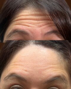 forehead wrinkle treatment via dysport