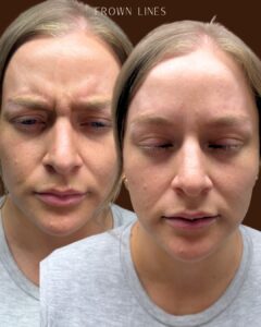 Frown line treatment with botox in Los Angeles