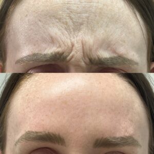frown line wrinkle treatment Los Angeles