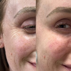 crows feet wrinkle treatment Los Angeles