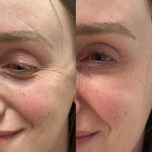 wrinkle treatment Los Angeles