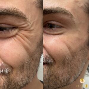 wrinkle reduction Los Angeles