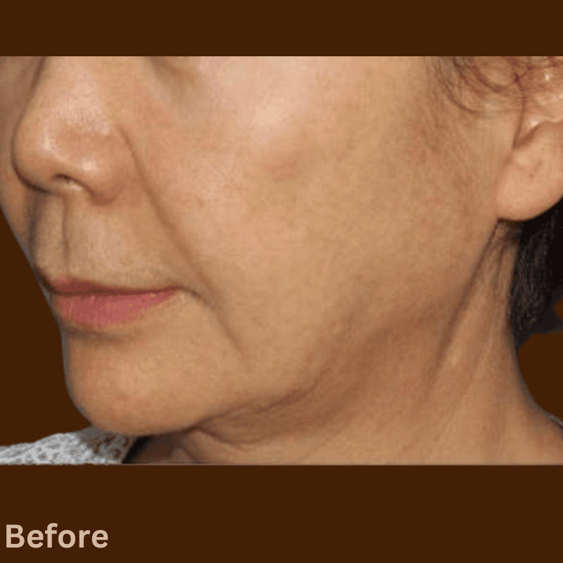 density rf before the treatment