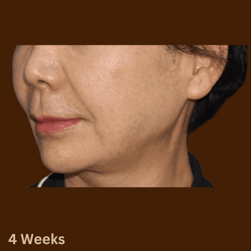 density rf after the treatment