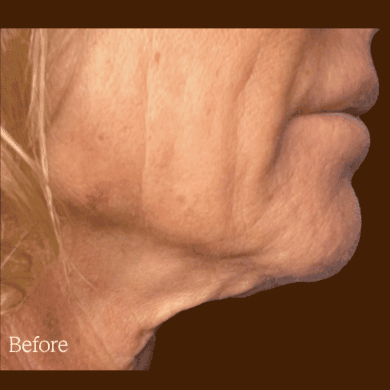 Density RF for wrinkles before
