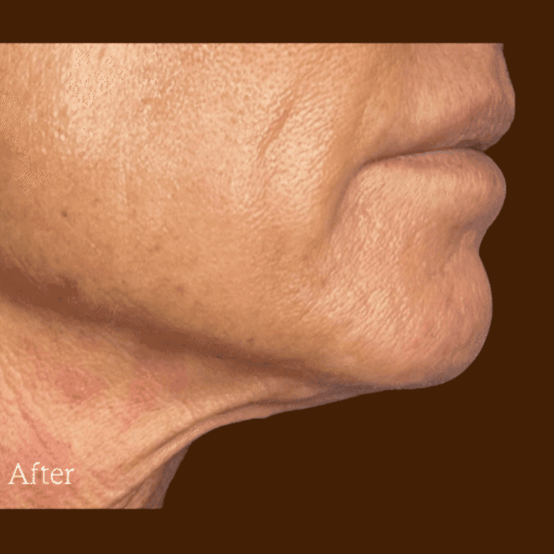 Density RF for wrinkles after