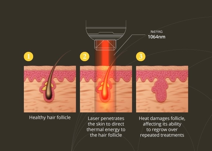 effective laser hair removal Los Angeles