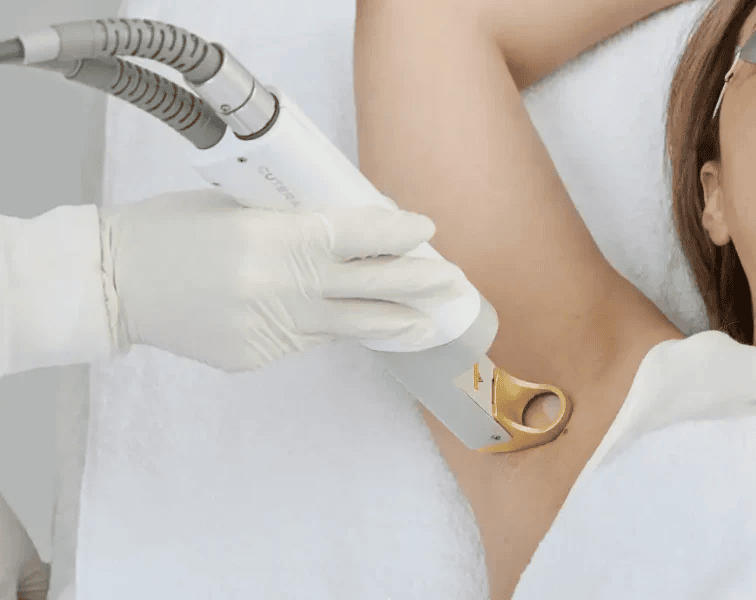 laser hair removal Los Angeles