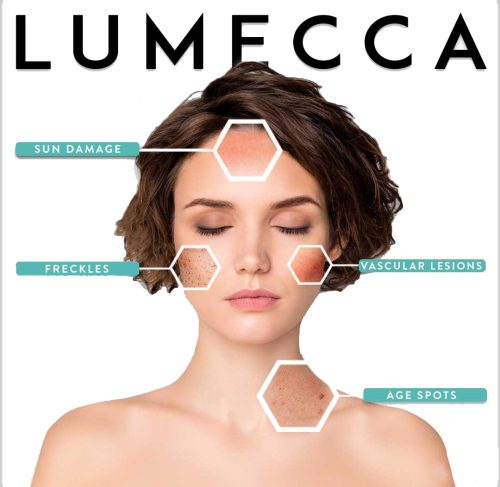 Best Lumecca IPL photofacial in Los angeles