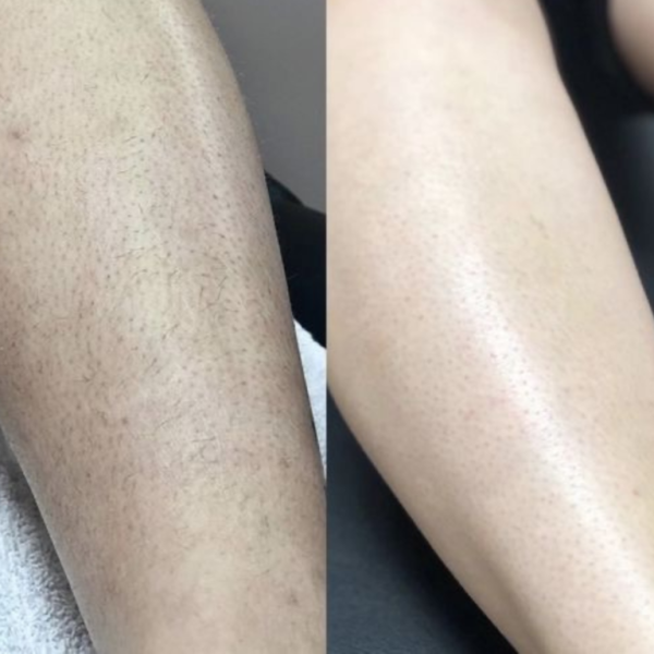Legs hair removal with laser