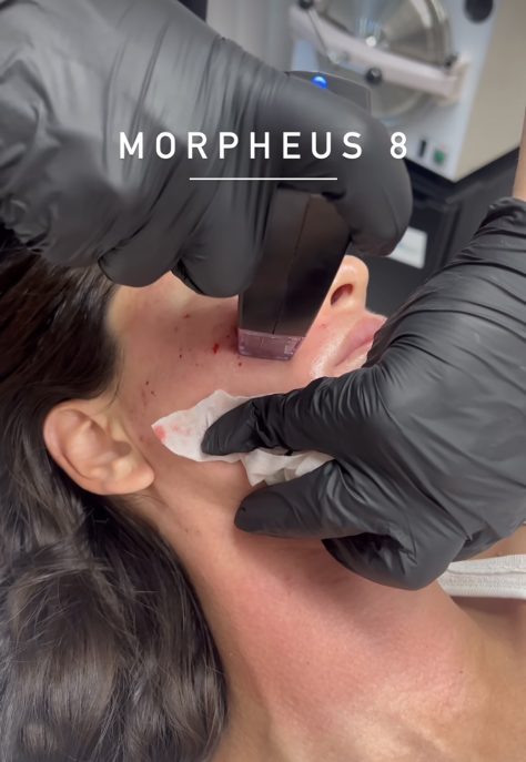Morpheus8 treatment for body and face