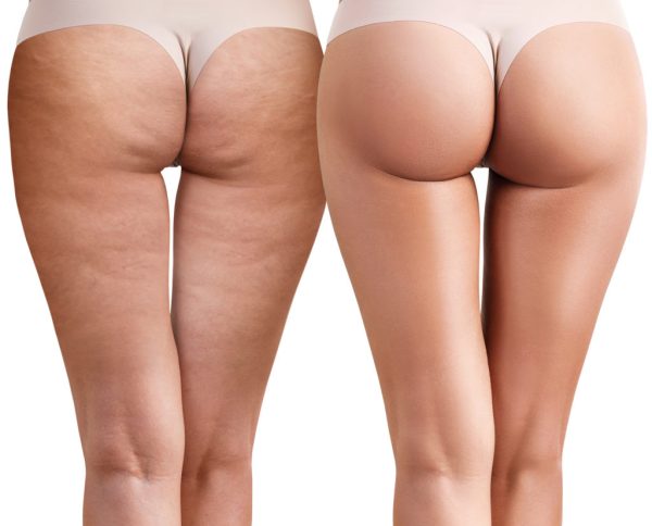cellulite treatment- before-after