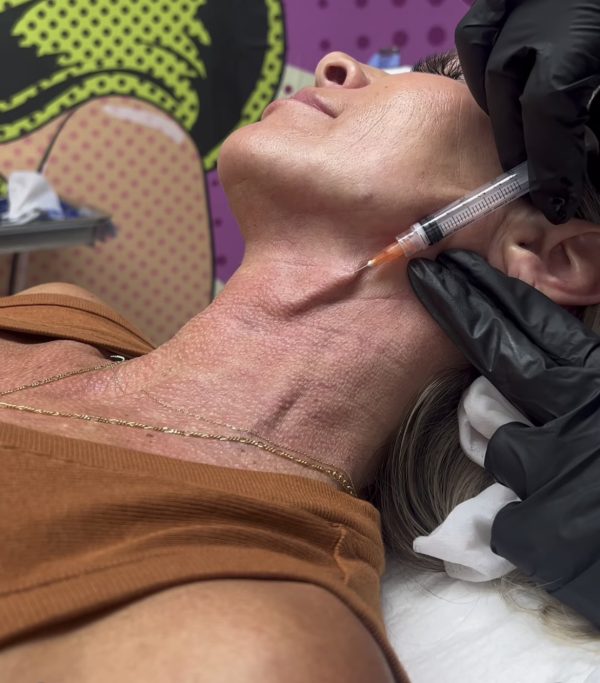 Sculptra injection on the neck Los Angeles